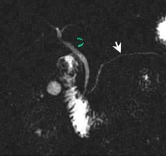 Comparison patient #3: normal MRCP Normal MRCP image showing the common bile duct (curved arrow) and the pancreatic duct (arrow).