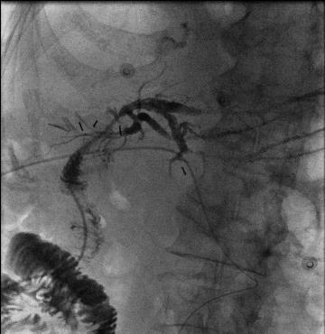 a normal cholangiogram our patient developed elevated