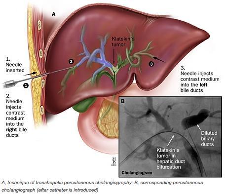 Recap: PTC PTC allows for imaging of and interventional access to the biliary system PTC can be