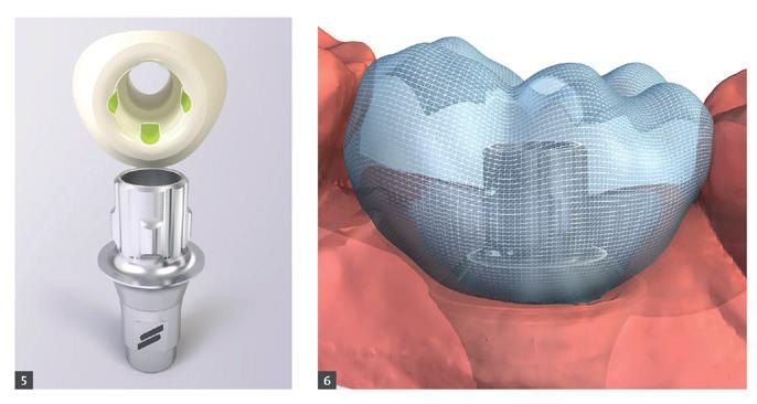 precious metal to more cost predictable solutions. Fig. 1: : Straumann Variobase Abutment with coping on Straumann RC 4.1 implant Fig. 2: Straumann Variobase Abutment with coping on Straumann WN 4.