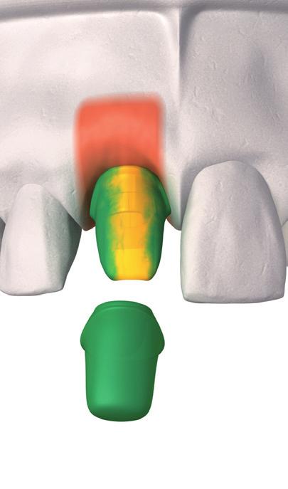 Assessing the location, proximity of adjacent teeth and occlusion, select the most appropriate preformed anatomical coping.