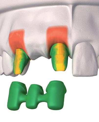 Multiple Unit Construction Laboratory Procedure A. Ensure the implant replicas are correctly seated on to the impression copings and pour the model in the usual manner.