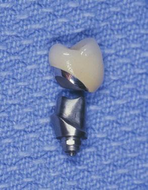 SYNOCTA MESO ABUTMENT SUPPORTED CROWN The definitive