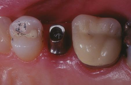 The synocta Meso abutment is then torqued to 35 Ncm,
