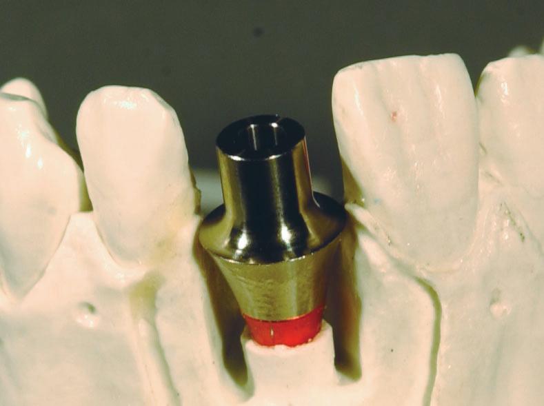 Make a lab putty index that will record the neutral zone of the edentulous space.