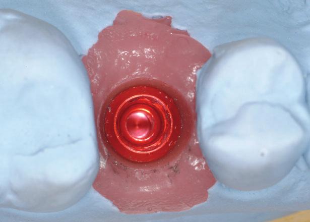 appointment The synocta Meso abutment is checked to