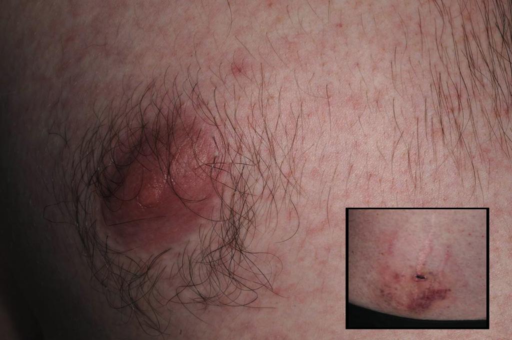 Zika Virus Infection Following a Monkey Bite Fig 1 Generalized maculopapular rash seen on the torso and arms, with a monkey bite mark on the right inferolateral torso. wards.