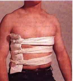 Bulky Dressing for splint of Flail Chest Use Trauma bandage and Triangular Bandages to splint