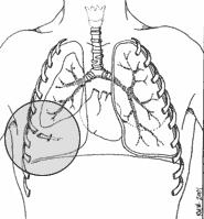 Simple/Closed Pneumothorax Opening in lung tissue that leaks air into chest