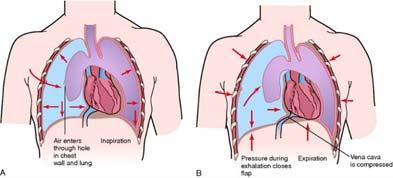 injuries Pheumothorax Tension pneumothorax Air entering chest cavity becomes trapped within pleural space Air enters pleural space during inspiration, cannot exit during exhalation 28 29 injuries