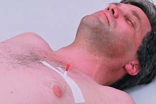 31 injuries Hemothorax Blood vessel in chest cavity injured, blood accumulates in pleural space Result of penetrating or blunt trauma, bleeding can be severe enough to cause shock Both hemothorax and