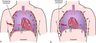 Paradoxical motion during breathing Flail segment tender, movable during palpation Underlying injury, pneumothorax
