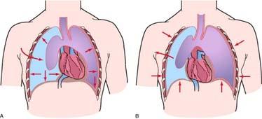injuries Pheumothorax Collection of air in pleural space that results in lung collapse Occurs when air enters normally closed space between linings of chest wall and lungs (visceral and parietal