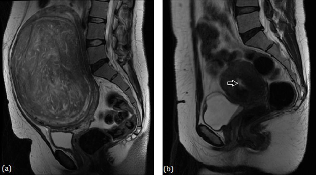 Fig. 10: (a) Pre-UAE T2-weighted MR image revealing an intramural fibroid with a