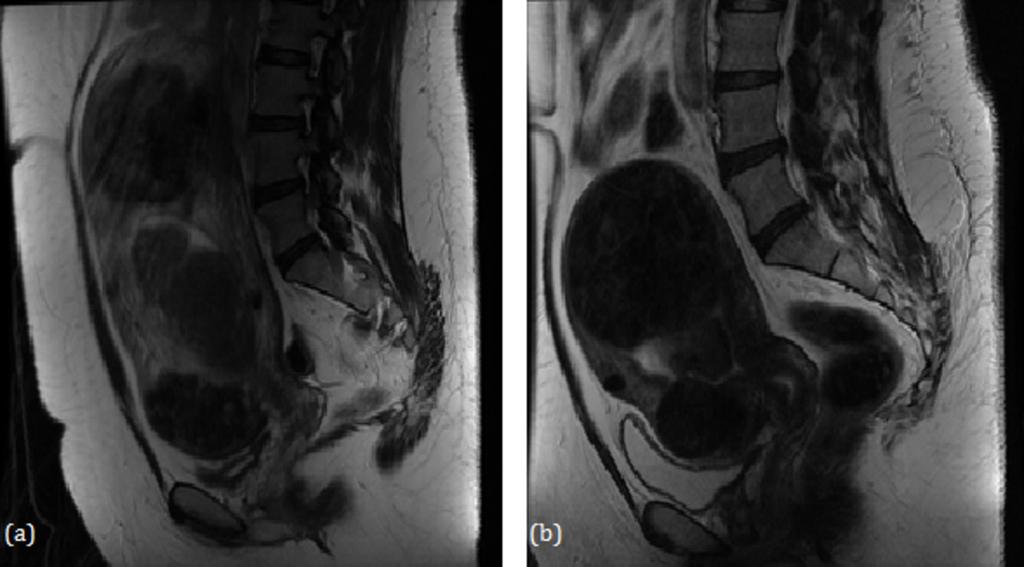 (b) 6 months post-uae T2-weighted MR image showing that the intramural fibroid has