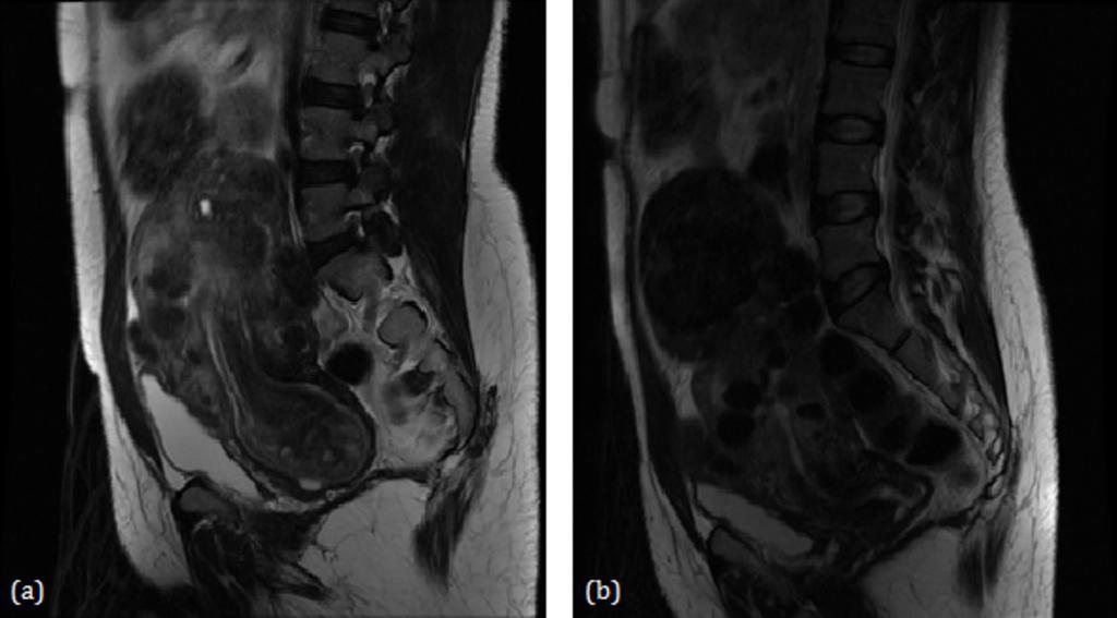 Fig. 11: (a) Pre-UAE T2-weighted MR image revealing an endocavitary fibroid with a maximum dimension of 9.5 cm.