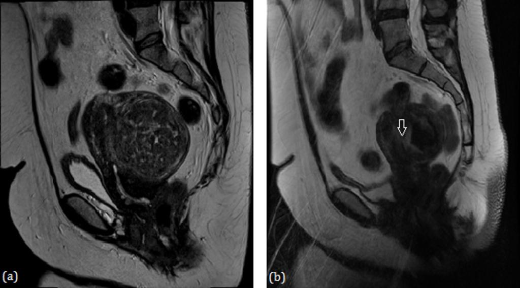Fig. 2: (a) Pre-UAE T2-weighted MR image showing a submucosal fibroid with a maximum dimension of 7.8 cm.