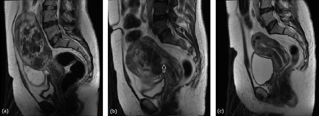 Fig. 5: (a) Pre-UAE T2-weighted MR image displaying an intramural fibroid and an endocavitary fibroid.