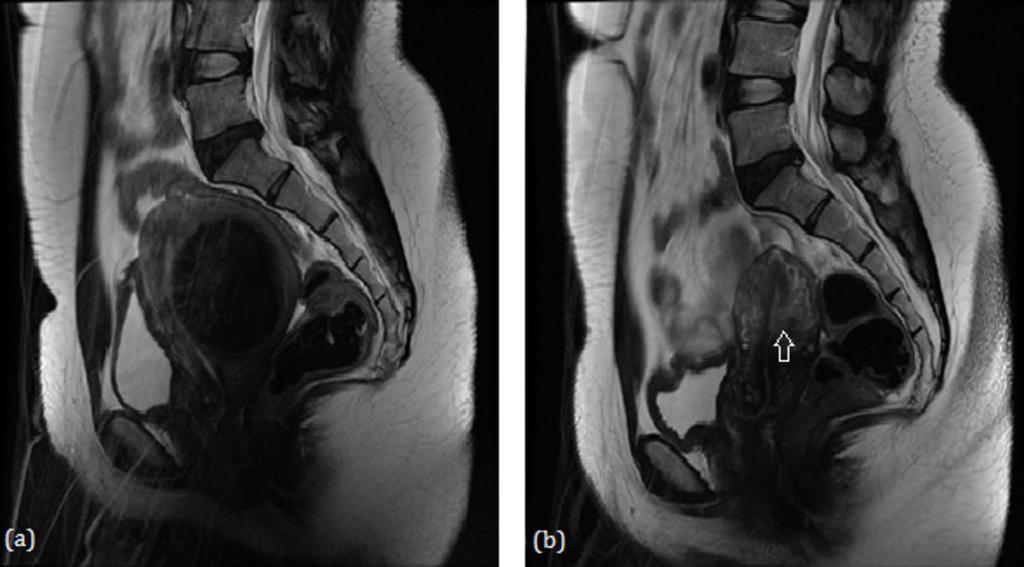 Fig. 8: (a) Pre-UAE T2-weighted MR image revealing an intramural fibroid with a maximum dimension of 11.7 cm.