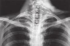 Clinical cases case 1 3 Clinical cases Case 1 CERVICAL RIB A young man has black areas of skin on the tips of his fingers of his left hand.