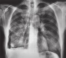 Thorax Case 2 LUNG CANCER A 52-year-old man presented with headaches and shortness of breath. He also complained of coughing up small volumes of blood.