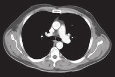 Pulmonary trunk C Superior vena cava Ascending aorta Pulmonary trunk Right main bronchus Esophagus Thoracic aorta Left pulmonary artery Right pulmonary artery Esophagus Thoracic aorta Fig. 3.