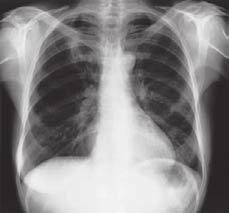 Regional anatomy Pleural cavities 3 In the clinic Lung cancer It is important to stage lung cancer because the treatment depends on its stage.