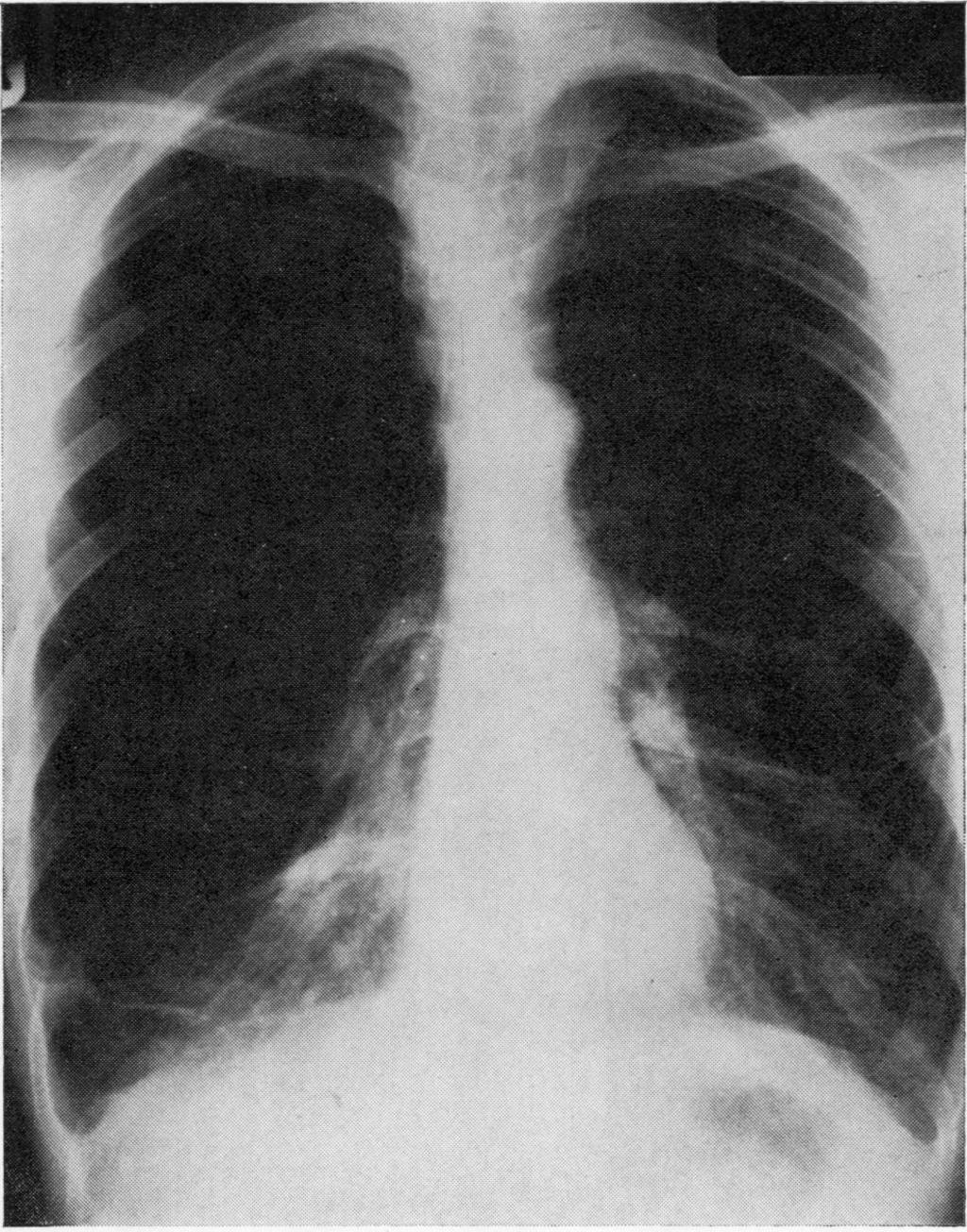 887 tuberculosis had postoperative complications (table 1). In one patient an air leak persisted for four months and in another a residual airspace required tube thoracostomy.
