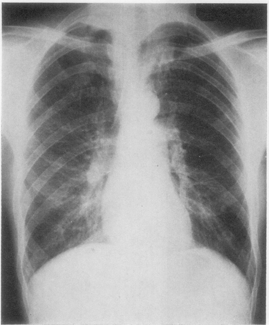 888 Table 4 Pulmonary functions after bullectomy Patient Before surgery After surgery Potgieter, Benatar, Hewitson, Ferguson Fig 2 Postoperative PA chest N radiograph in patient 7.