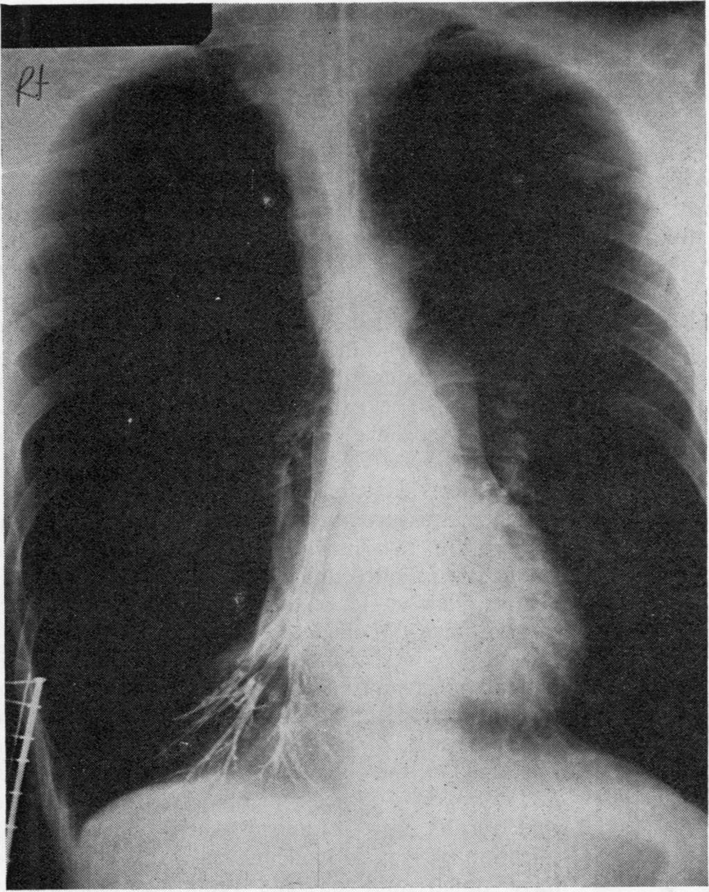 Surgical treatment of bullous lung disease from associated obstructive lung disease.