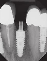 and treatment planning Be aware of what is tried and true and the trend in implant