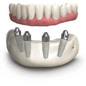 Session 4 May 19-20 All-on-4, 5 or 6: Immediate Loading for Full Arch Fixed Porcelain Restorations The TeethXpress (All-on-4) Treatment Concept: Developing a Surgical-Prosthetic Blueprint for Success