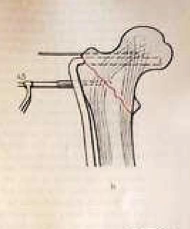 7. DHS Commonly used for Trochanteric fracture, undisplaced fracture neck of femur and Subtrochanteric fracture Femoral neck: causes large bending loads on fixation hardware.