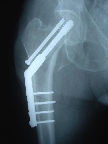 Perpendicular to the fracture: cause impaction The aim of fixation systems for this fracture is to use the perpendicular component to gain stability.
