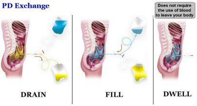 Peritoneal Dialysis Catheter CLICK TO ENLARGE IMAGE A small, soft tube called a catheter is put through the wall of your abdomen into the peritoneal cavity.