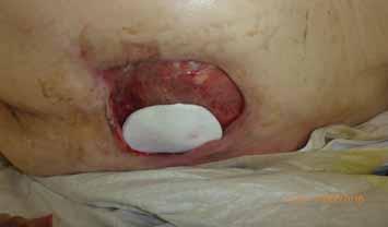 In this way, the secretion does not lead to a maceration of the wound margins if the wound dressing is moist. 3.