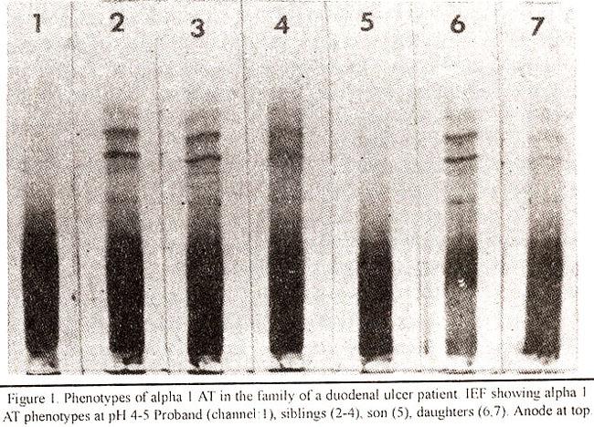 One of the sibling had a low level on the partigen plate and IEF showed a pattern that looked like a heterozygous variant that was not clearly resolved into MM or MZ.