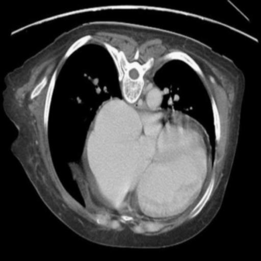 PROPOSED SYSTEM In this, available lung CT scan images are passed through the system which is having following stages: pre-processing stage, segmentation stage, feature Extraction stage and