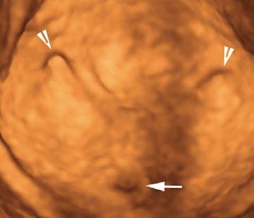 Virtual Cystoscopy using Volume Ultrasound Volume Ultrasound deals with the acquisition of large volumes of ultrasound data.