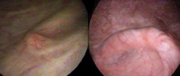 Case 2: A middle-aged male presented with a diagnosis of left-sided ureterocele.