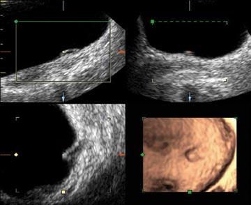 as clearly as cystoscopy. The rendered image on Volume Ultrasound compared favorably with the cystoscopy (Fig 5 and Fig 5a).