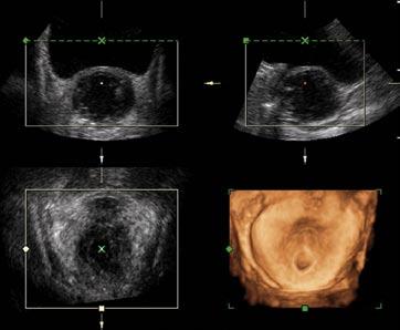 sono-cystoscopic views. Fig 7a: Conventional cystoscopic view of the prostatic enlargement causing the mass effect.