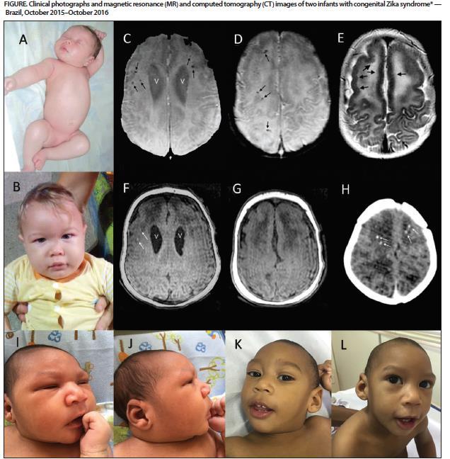 Emerging Data on Congenital Zika Virus Infection Eye problems in infants without microcephaly or other brain anomalies Postnatal-onset microcephaly in infants Postnatal-onset hydrocephalus