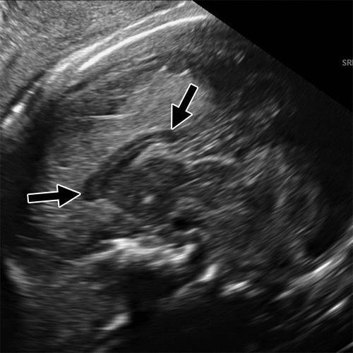 Special Considerations for the Prenatal Diagnosis of Congenital Zika Virus Infection Prenatal Ultrasound Prenatal ultrasound findings associated with