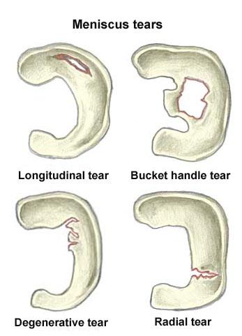 ACL injuries -Most common are radial tears in posteromedial compartment (avascular zone) (12) -Meniscal tear