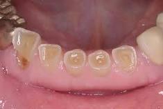 Patients with rampant caries. Patients with xerostomia.