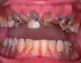 High risk group and rampant caries (every 3 or 6