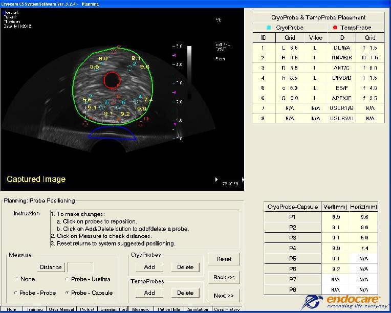 CryoGuide Planning Placement Measurements Key measurements can be checked on screen