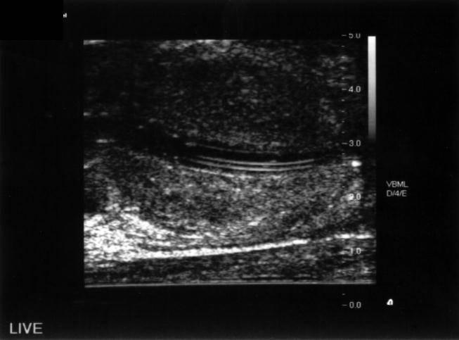 Ultrasound Basics Longitudinally oriented side fire linear array transducer displays prostate in long axis Probe