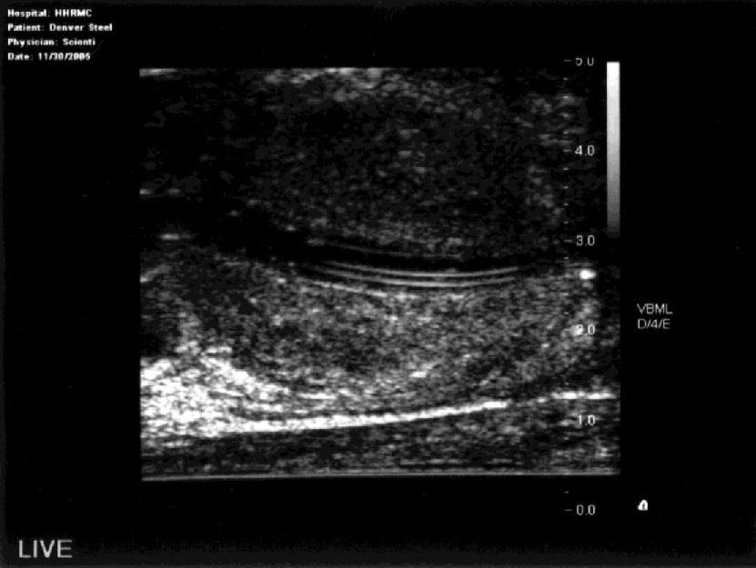 Normal Ultrasound Anatomy Layers of Rectal Wall Peri-rectal/ peri-prostatic fat